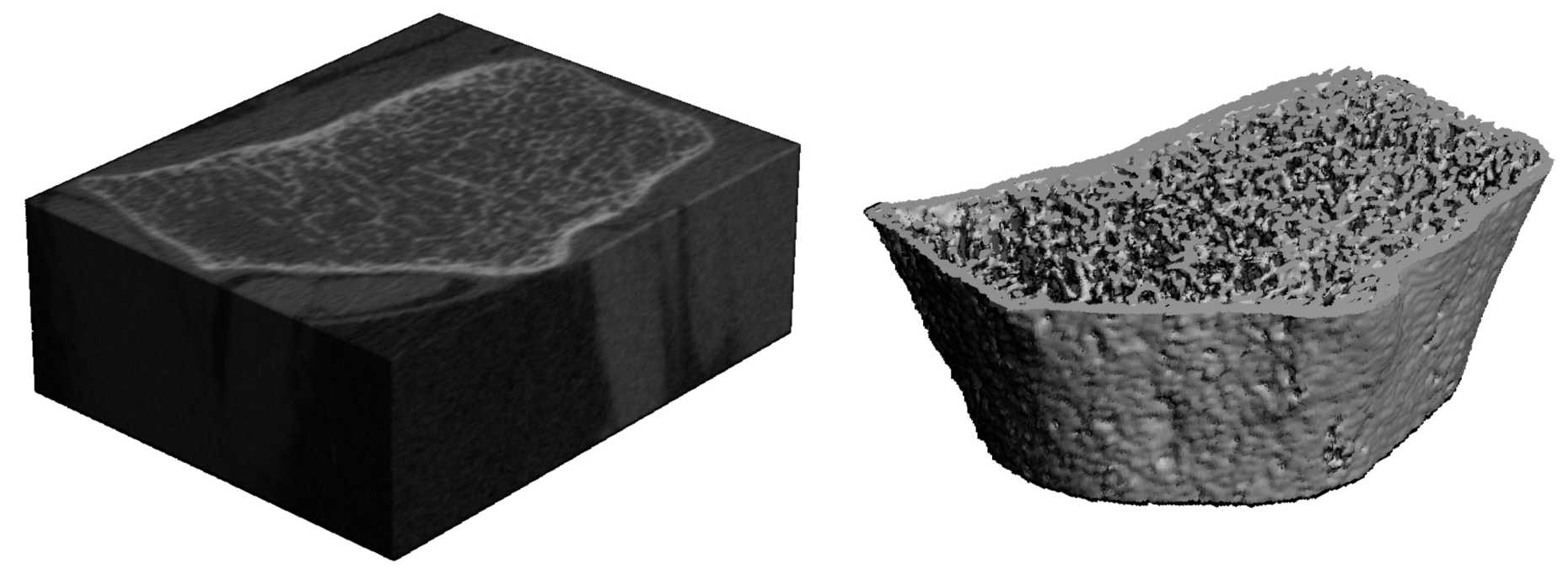 Enlarged view: In silico bone health prognosis